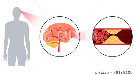 Brain stroke ishemic 79138106