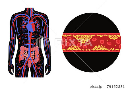 Mesentric ishemia disease Mesentric ishemia disease 79162881