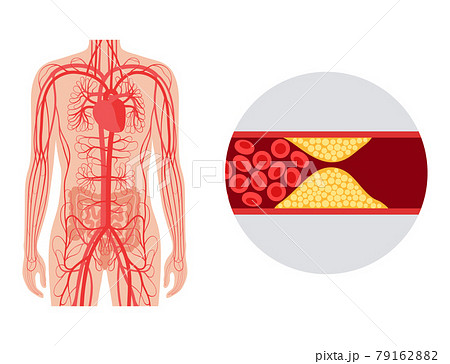 Mesentric ishemia disease 79162882