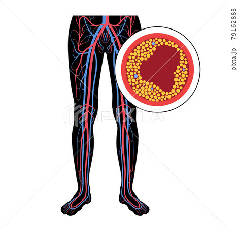 Peripheral artery disease 79162883