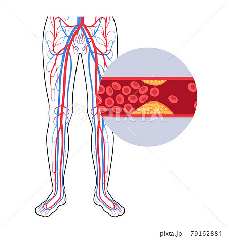 Peripheral artery disease Peripheral artery disease 79162884