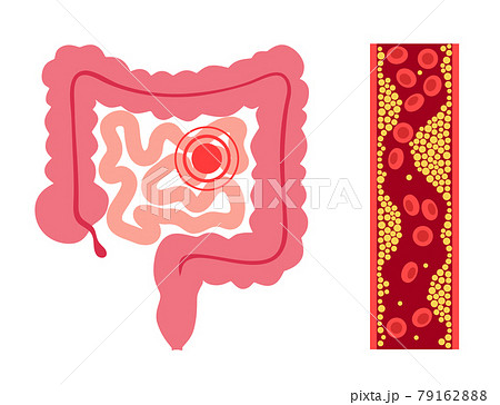 Mesentric ishemia disease 79162888