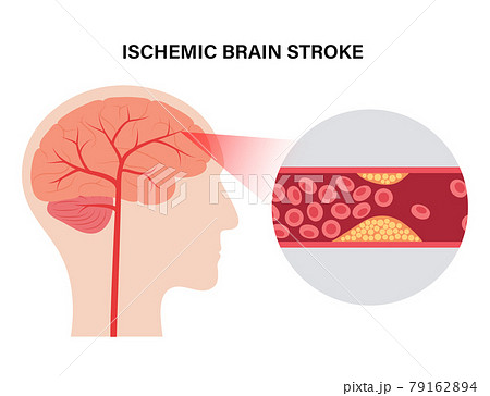 Brain stroke ishemic Brain stroke ishemic 79162894
