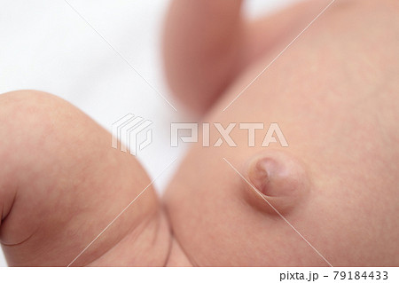 臍ヘルニアの赤ちゃんのおへそ 79184433