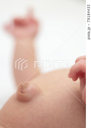 臍ヘルニアの赤ちゃんのおへそ 79184435