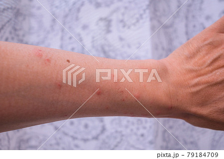 毛虫皮膚炎【発症4日目】 79184709