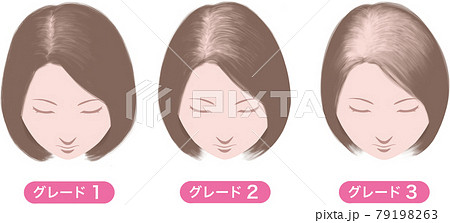 女性の男性型脱毛症、ルートヴィヒの分類、グレード表記 79198263