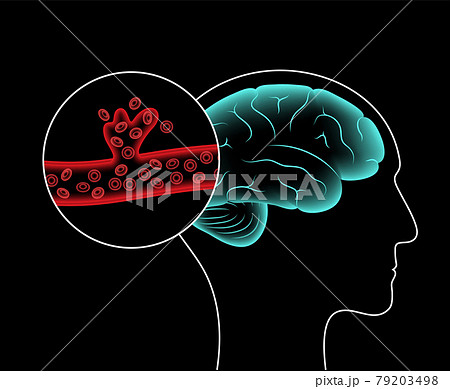 Brain stroke hemorrhagic Brain stroke hemorrhagic 79203498