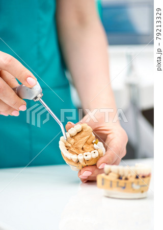 The dentist's hand holds an artificial jaw mock-up and shows the patient's teeth. Treatment in a dental clinic. Close-up. The dentist's hand holds an artificial jaw mock-up and shows the patient's teeth. Treatment in a dental clinic. Close-up. 79213329