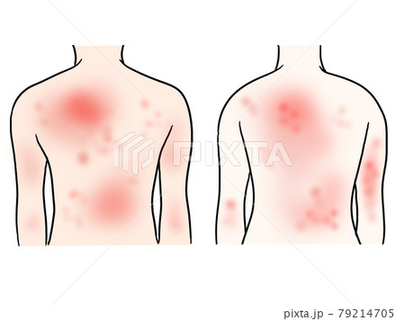 皮膚炎の男女2人背中のイラストのイラスト素材