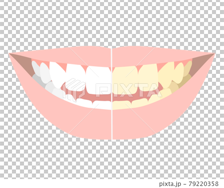 ホワイトニング 歯の着色の比較のイラスト素材