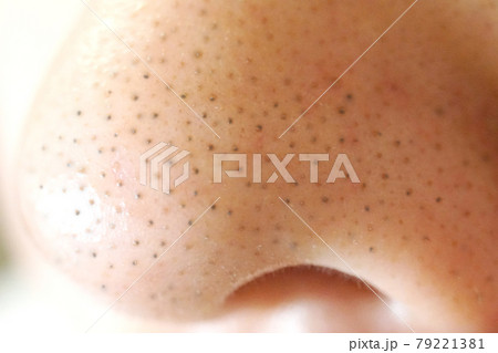 鼻の毛穴・黒ずみ（横顔アップ） 79221381