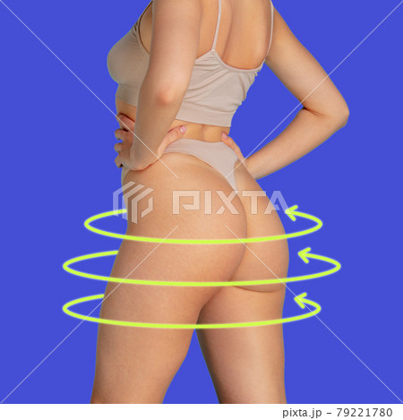 Marks on the women's buttocks, waist and legs before plastic surgery. 79221780