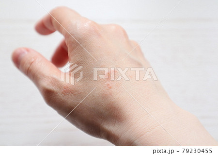 皮膚炎 肌トラブル 肌荒れ 湿疹  手湿疹 主婦湿疹 家事湿疹 14  79230455