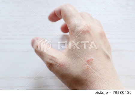 皮膚炎 肌トラブル 肌荒れ 湿疹 手湿疹 主婦湿疹 家事湿疹 13 皮膚炎 肌トラブル 肌荒れ 湿疹 手湿疹 主婦湿疹 家事湿疹 13 79230456