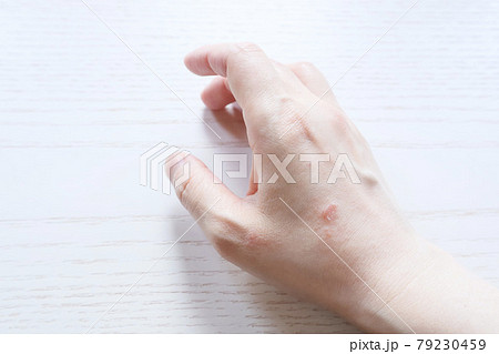皮膚炎 肌トラブル 肌荒れ 湿疹  手湿疹 主婦湿疹 家事湿疹 10  79230459