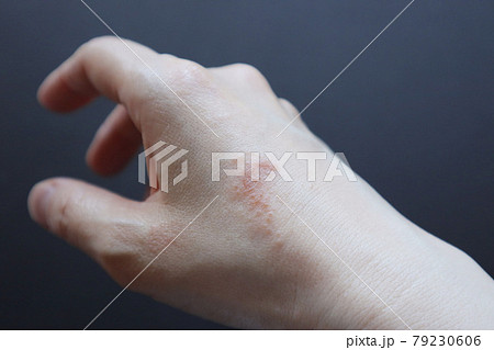 皮膚炎 肌トラブル 肌荒れ 湿疹  手湿疹 主婦湿疹 家事湿疹 20  79230606