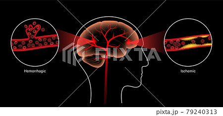 Brain stroke ishemic and hemorrhagic Brain stroke ishemic and hemorrhagic 79240313