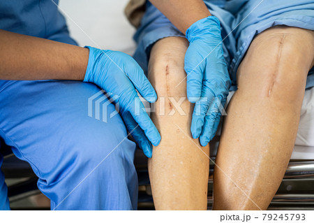 Asian senior or elderly old lady woman patient show her scars surgical total knee joint replacement Suture wound surgery arthroplasty on bed in nursing hospital ward, healthy strong medical concept. Asian senior or elderly old lady woman patient show her scars surgical total knee joint replacement Suture wound surgery arthroplasty on bed in nursing hospital ward, healthy strong medical concept. 79245793