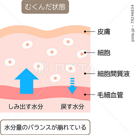 むくみのしくみ 肌の断面図のイラスト素材