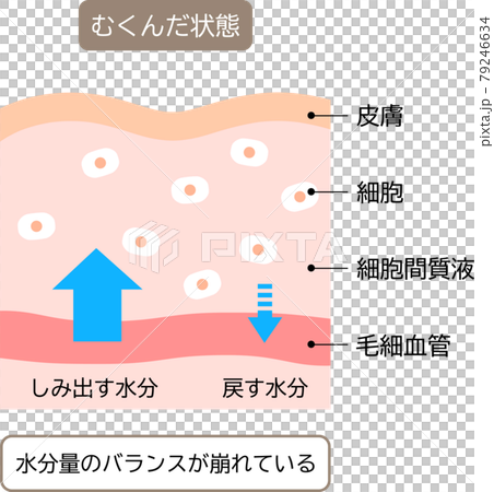 むくみのしくみ　肌の断面図 79246634
