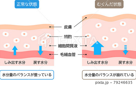 むくみと正常な肌のしくみ 断面図 ビフォアアフター むくみと正常な肌のしくみ 断面図 ビフォアアフター 79246635