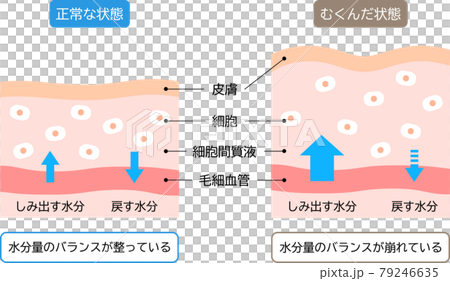 むくみと正常な肌のしくみ 断面図 ビフォアアフター むくみと正常な肌のしくみ 断面図 ビフォアアフター 79246635