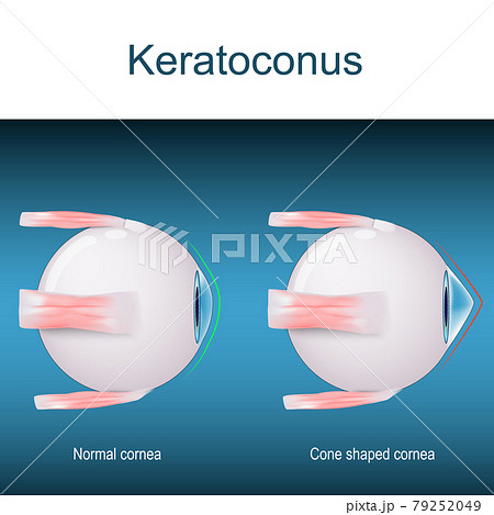 Keratoconus. eyes disorder 79252049