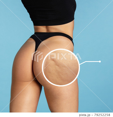 Young female body on blue background. Cellulite and problem skin concept. Young female body on blue background. Cellulite and problem skin concept. 79252258