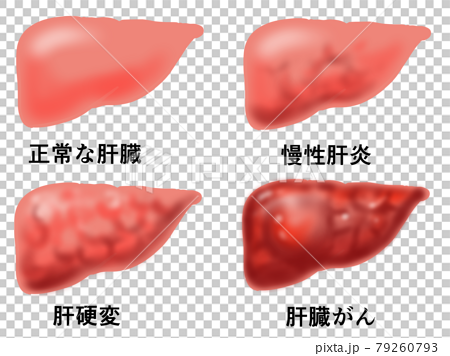 肝臓の病気 4つのイラストのイラスト素材