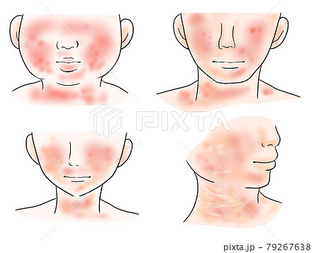 大人と子供のアトピー皮膚炎のイラストのイラスト素材