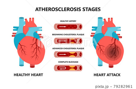 Heart attack and atherosclerosis stages. Healthy and unhealthy arteries. Cholesterol in the blood vessels. 79282961