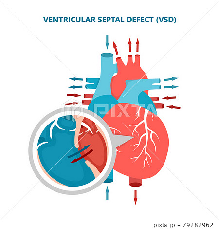 Ventricular septal defect VSD with heart blood flow. Human heart muscle diseases cross-section. 79282962