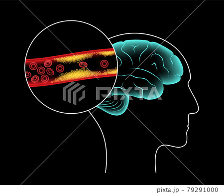 Brain stroke ishemic Brain stroke ishemic 79291000