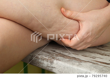 Woman shows holding and pushing the skin of the legs cellulite, orange peel. Woman shows holding and pushing the skin of the legs cellulite, orange peel. 79295740