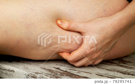Woman shows holding and pushing the skin of the legs cellulite, orange peel. Woman shows holding and pushing the skin of the legs cellulite, orange peel. 79295741