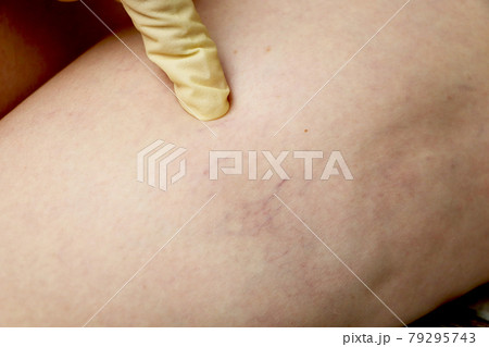 Varicose veins and capillary veins in the legs. Medical inspection and treatment Varicose veins and capillary veins in the legs. Medical inspection and treatment 79295743