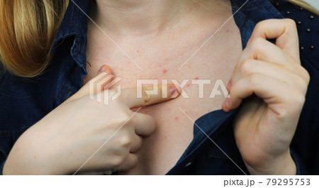 Allergy concept. Young woman with pimples on the chest, closeup Allergy concept. Young woman with pimples on the chest, closeup 79295753