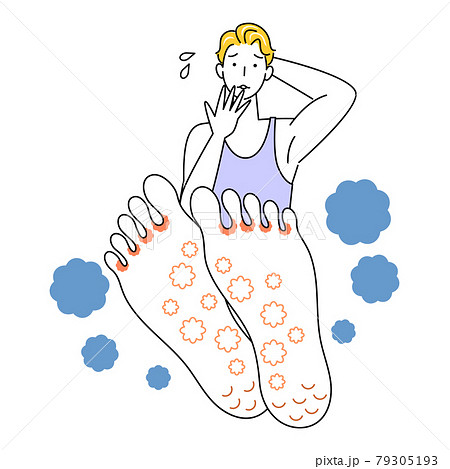 スキンケア 足が水虫になってしまい悲しんでいる可愛い男性 足裏のアップ イラスト ベクター 79305193