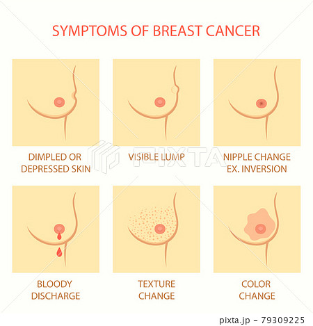 breast cancer, self examination, tumor 79309225