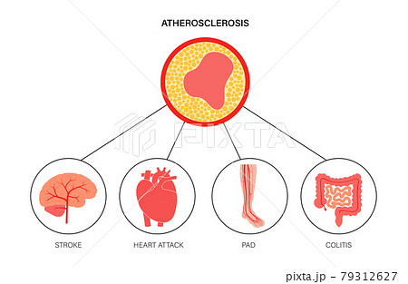 Types of ishemia 79312627