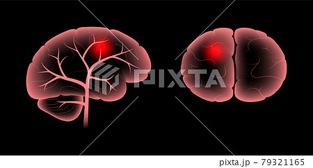 Brain pain disease 79321165
