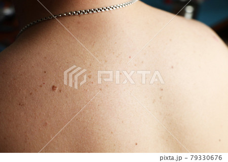 Close up detail of the bare skin on a man back with scattered moles and freckles , Disorders of body , Checking benign moles , Sun effect on skin. Close up detail of the bare skin on a man back with scattered moles and freckles , Disorders of body , Checking benign moles , Sun effect on skin. 79330676