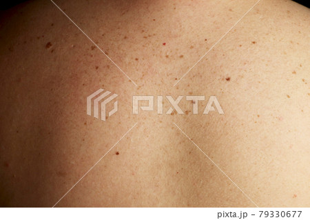 Close up detail of the bare skin on a man back with scattered moles and freckles , Disorders of body , Checking benign moles , Sun effect on skin. Close up detail of the bare skin on a man back with scattered moles and freckles , Disorders of body , Checking benign moles , Sun effect on skin. 79330677
