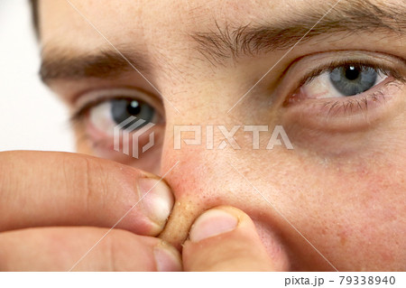 Closeup portrait young man looking at the camera, squeezing acne or blackheads on the nose. Close-up as background for the hygiene of the face and nose. Dermatology and skin problems. Oily skin face Closeup portrait young man looking at the camera, squeezing acne or blackheads on the nose. Close-up as background for the hygiene of the face and nose. Dermatology and skin problems. Oily skin face 79338940