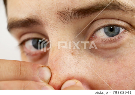 Closeup portrait young man looking at the camera, squeezing acne or blackheads on the nose. Close-up as background for the hygiene of the face and nose. Dermatology and skin problems. Oily skin face 79338941