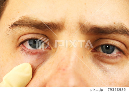 Conjunctivitis, tired eyes, red eyes, eye disease 79338986
