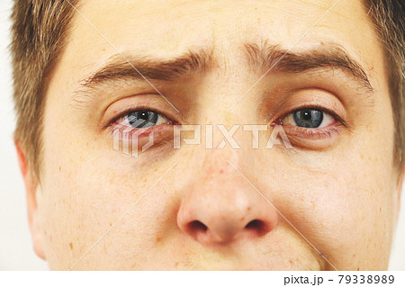 Conjunctivitis, tired eyes, red eyes, eye disease 79338989