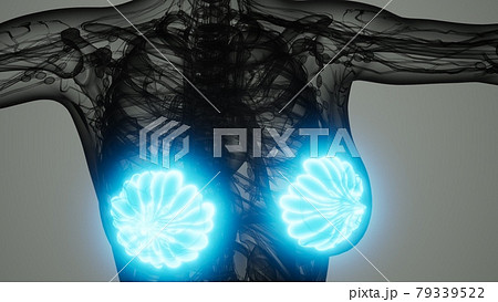 medical scan of Woman Breast Cancer 79339522