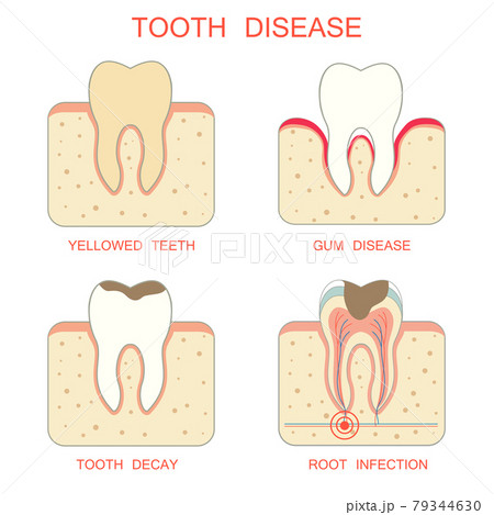 tooth decay disease tooth decay disease 79344630